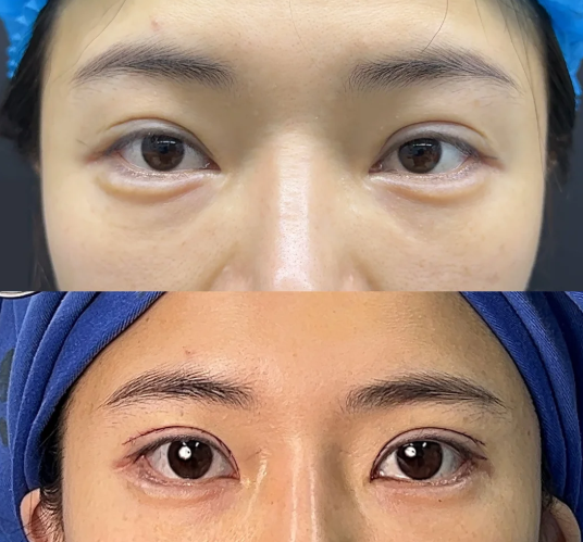 上海双眼皮修复医生杜园园和张楚谁做双眼皮修复技术好？