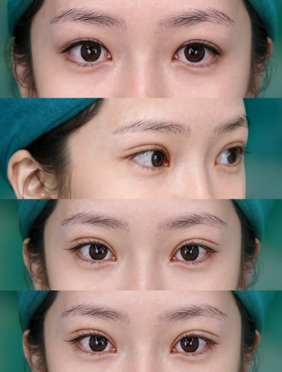 上海眼修复专家马娟和郑小红哪个医生做双眼皮修复好？