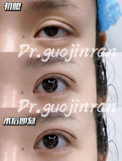 郑州郭金冉和孟宝玺割双眼皮哪个好？郭金冉孟宝玺做双眼皮预约电话