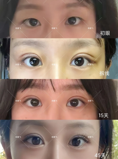 北京双眼皮专家敖健飞、张大艳、李燕哪个医生做双眼皮最好？