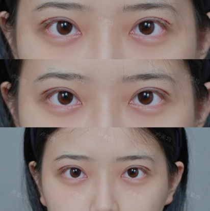 重庆卢美均和王方鹏哪个医生做双眼皮好？卢美均和王方鹏技术咨询预约电话