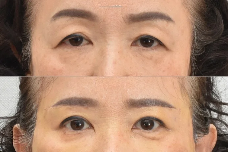 北京陈圣英和梁伟中哪个医生眼周抗衰效果好？陈圣英梁伟中眼部年轻化预约咨询电话