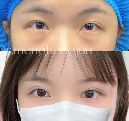 大连知名双眼皮专家孟洪君、李研、杨熙哪个医生好？