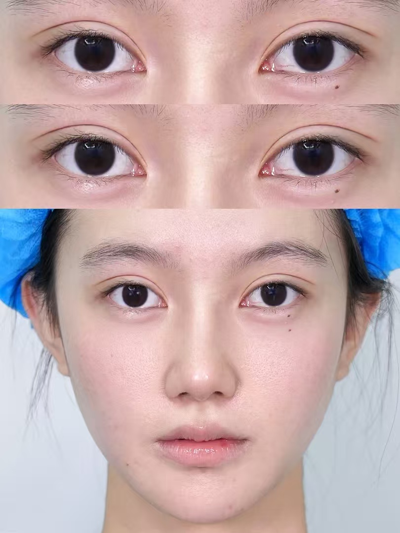 上海双眼皮医生哪个比较好？罗施、刘宇银、张蕾蕾、常梦玲、李欣豫、管果谁口碑好？