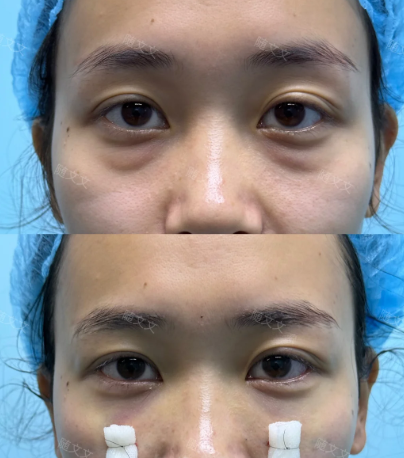 郑州随文文和何永强哪个医生做双眼皮技术好？随文文何永强双眼皮口碑谁好？