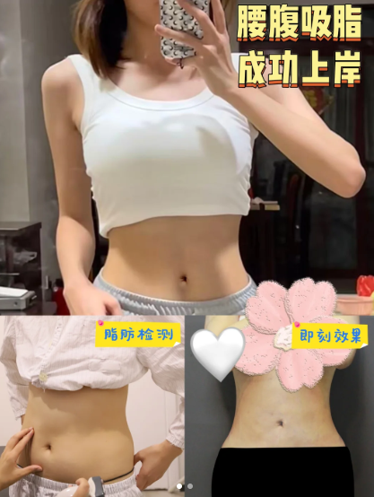 2026年成都吸脂哪个医生做得最好？赵善军、郑方荣、王欣、李祥彬、赵善军？