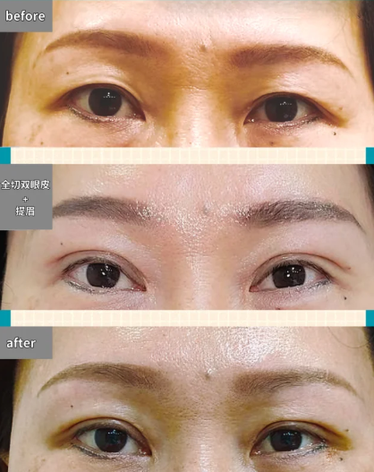 成都李焰和王立鹏割双眼皮哪个好？李焰和王立鹏割双眼皮技术怎么样？