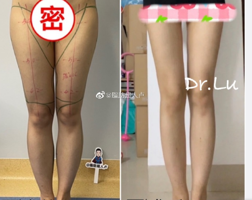 卢新蕾吸脂真的好吗，吸脂会凹凸不平吗？