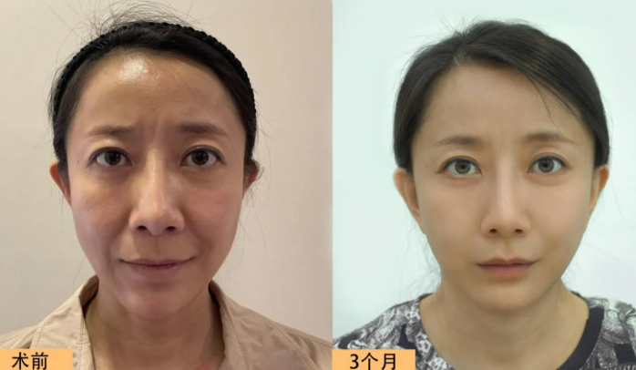 北京面部提升专家赵延勇、杜太超、王春虎、袁强谁做提升好？
