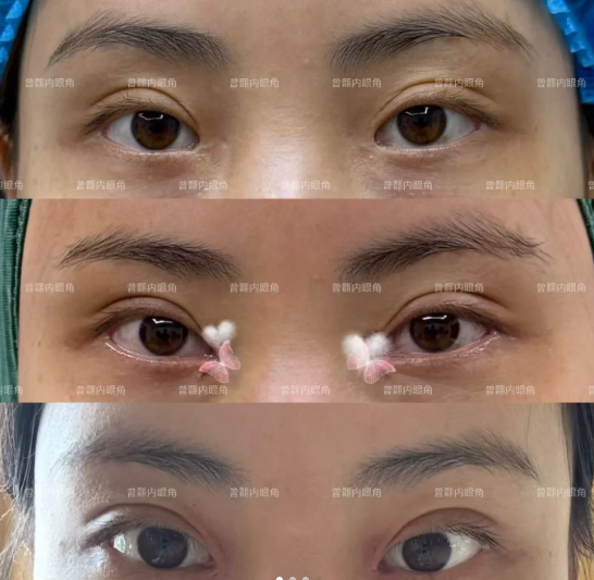 上海双眼皮修复专家曾翾和马娟医生哪个做眼修复技术好？