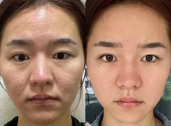 北京王春虎和谢洋春哪个医生做拉皮好？王春虎和谢洋春面部提升谁技术更好？