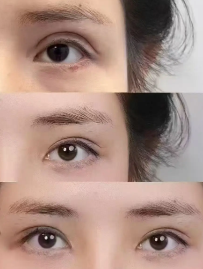 上海马娟和卢玲两位医生哪个修复眼睛好？马娟和卢玲眼修复怎么预约？