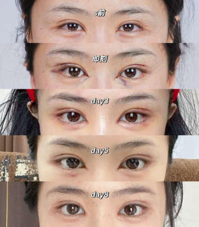 上海双眼皮修复专家杨海平和马娟两个医生做眼修复哪个好？