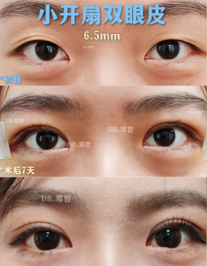 苏州做双眼皮专家邓哲和谢晓明哪个医生做双眼皮口碑好？