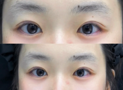 苏州割双眼皮专家秦丹莹和尹飞做双眼皮技术水更好？