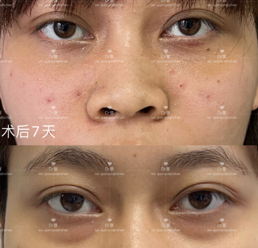 南宁覃朝和蒙旭昌哪个医生去眼袋比较好？覃朝和蒙旭昌预约电话