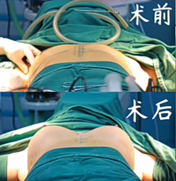 南京假体隆胸夏建军和沈干哪个医生口碑好？夏建军和沈干做丰胸谁技术更好？