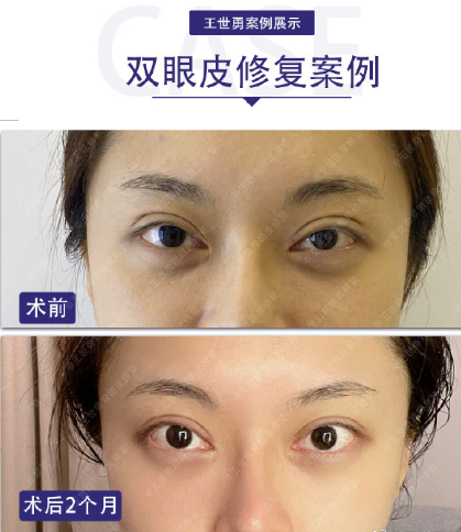刘志刚和王世勇谁做眼修复技术厉害？