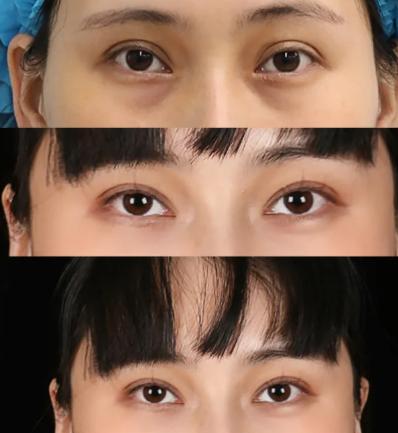 西安双眼皮修复哪个医生好？求推荐！陈杰、卢林涛、韩悦、孙峰谁最好？